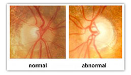 Visions Plus - Glaucoma Eye Diagram